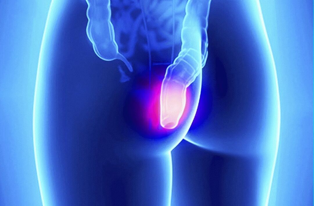 Gelarex kann sowohl äußerlich als auch rektal angewendet werden.